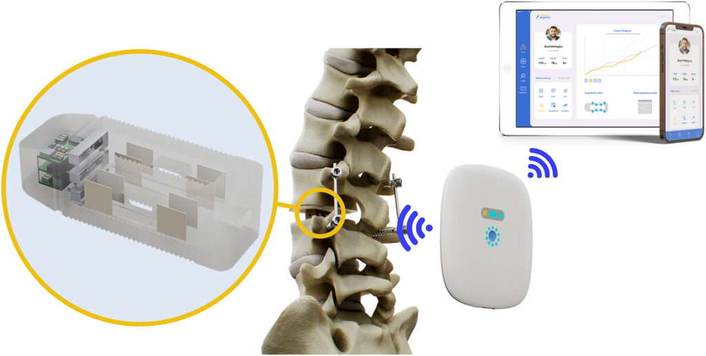 Smart Spine Implants